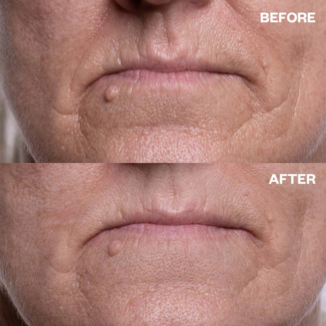 Mouth & Lip Wrinkle Patches - Image 4