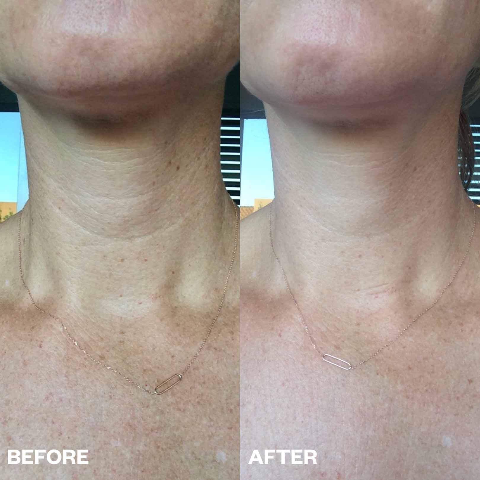 Jowl & Neck Lift Bundle - Image 5