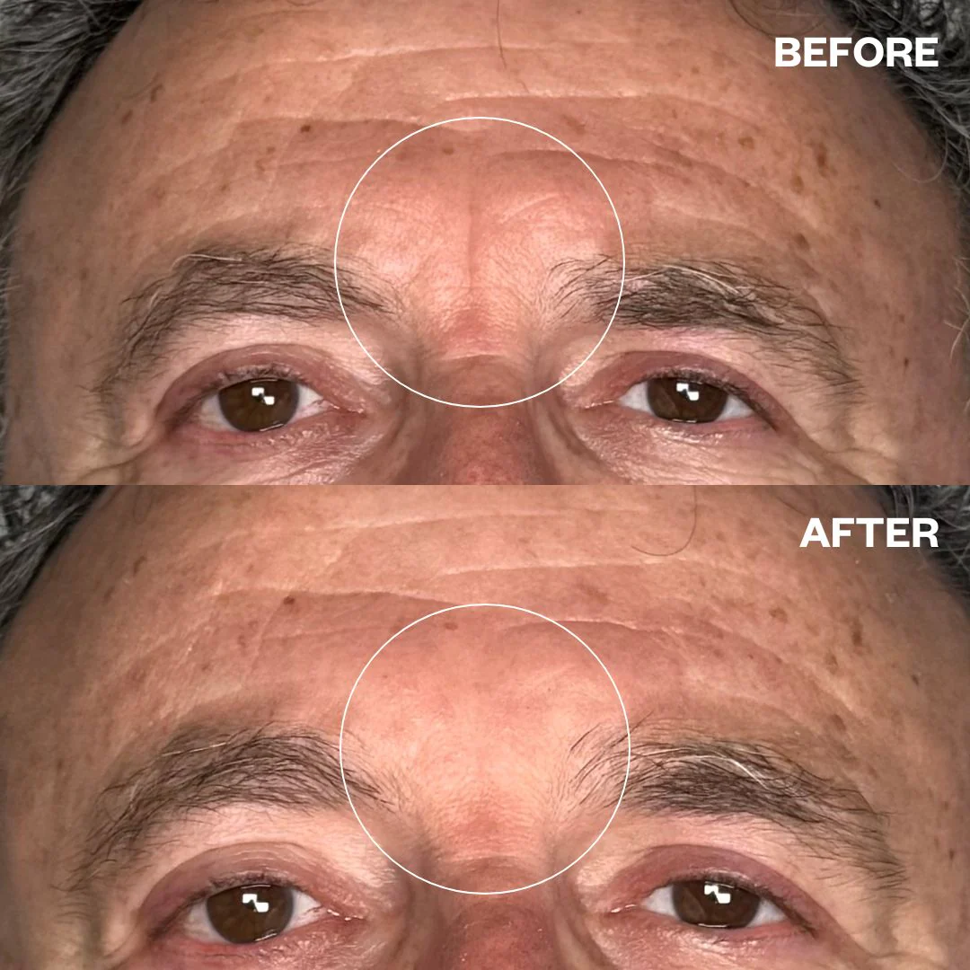 Men's Pro Forehead Wrinkle Patch - Image 3