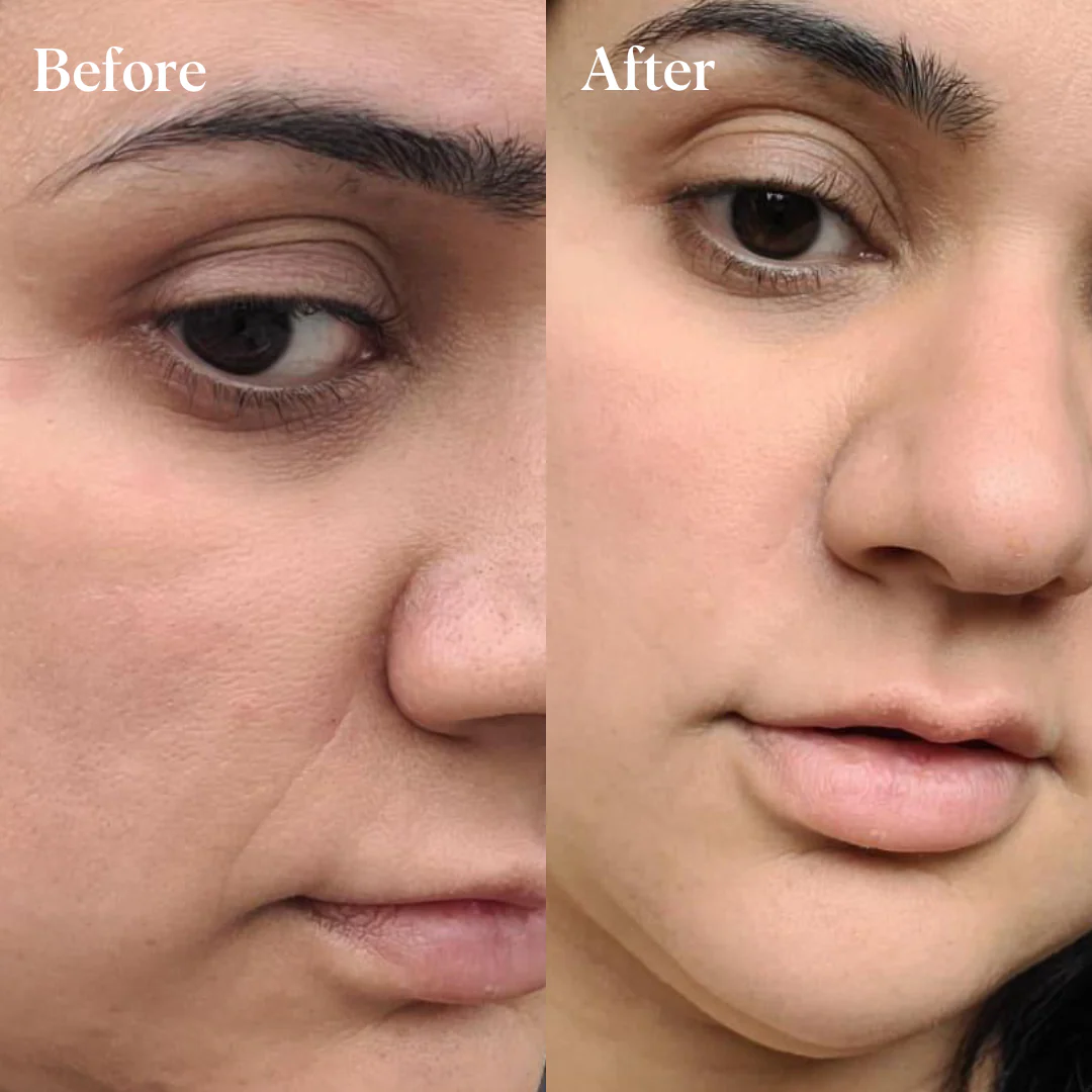 Under-Eye Lift Bundle - Image 5