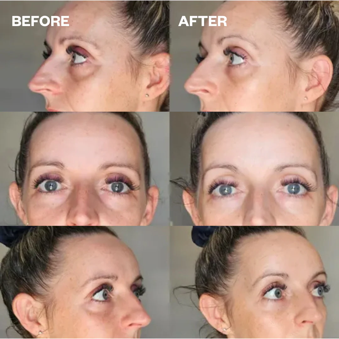 Under-Eye Lift Bundle - Image 7